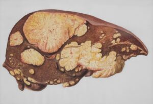 The Importance of Regular Liver Screening for Detecting Early Signs of Disease